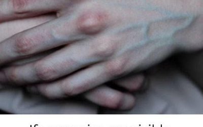 What the Veins on Your Hands Might Reveal About Your Liver Health…seee more below