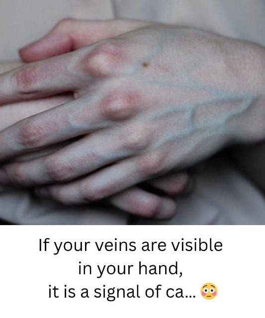 What the Veins on Your Hands Might Reveal About Your Liver Health…seee more below