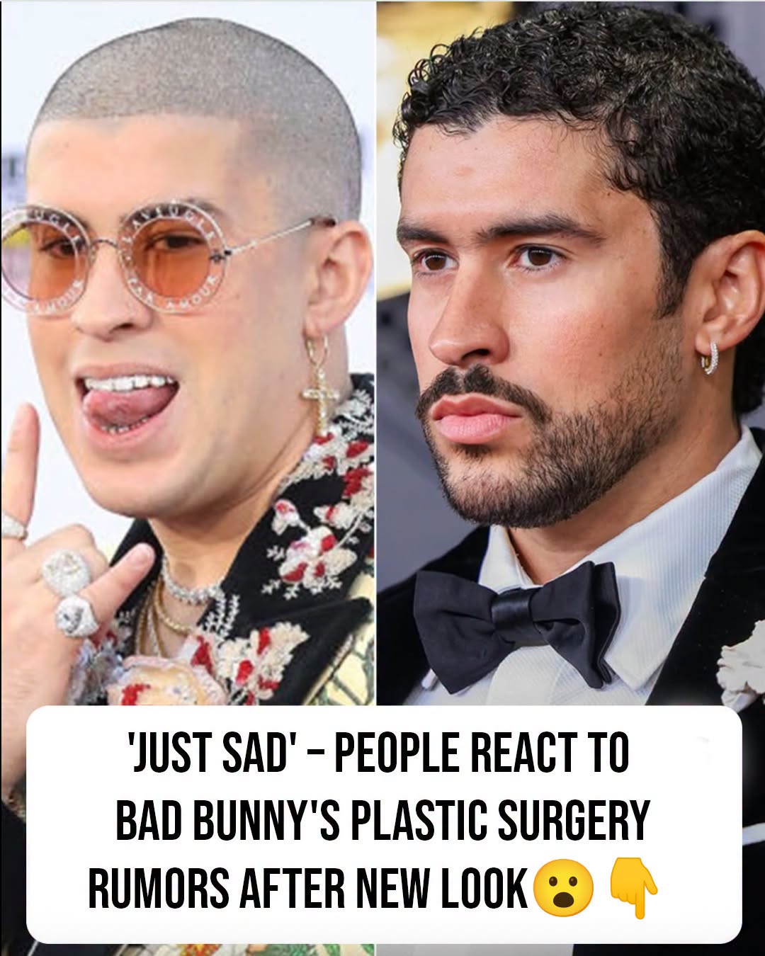 Bad Bunny sparks plastic surgery rumors after dramatic transformation at the Grammys