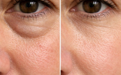 Place this 1 trick under your eyes and get rid of puffiness, swelling, and tired sagging skin. Full article 👇 💬