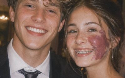 Only One Boy Asked Me To Prom Because Of My Birthmark—Until An Officer Walked In