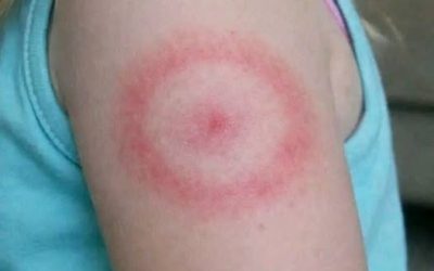 My Daughter Woke Up With a Strange Red Ring on Her Arm: A Parent’s Guide to Ring-Shaped Rashes (And When to Breathe Easy)