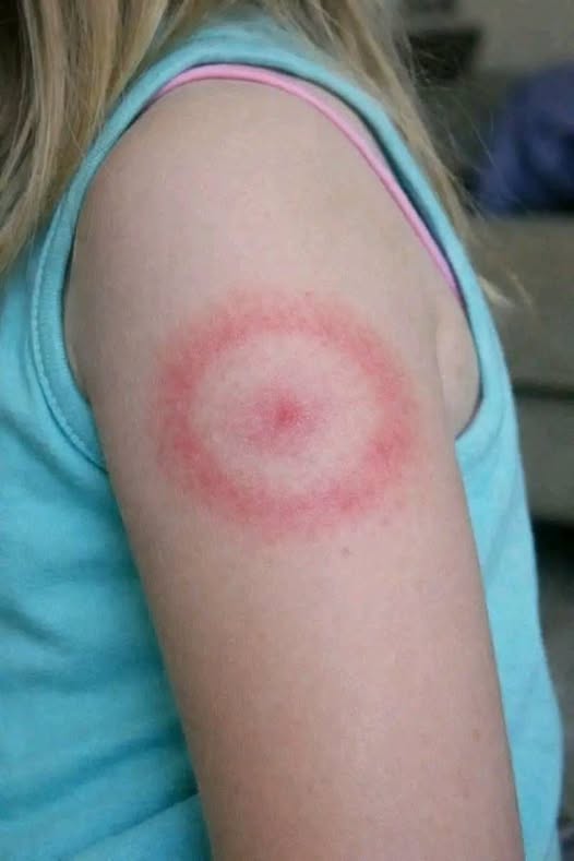 My Daughter Woke Up With a Strange Red Ring on Her Arm: A Parent’s Guide to Ring-Shaped Rashes (And When to Breathe Easy)