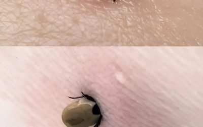 Never try to remove a tick with oil. ⛔️A doctor showed how to remove a tick correctly and extremely quickly — not even a minute has passed.