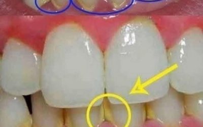 Can You Remove Dental Plaque Naturally in 5 Minutes? Here’s What You Should Know