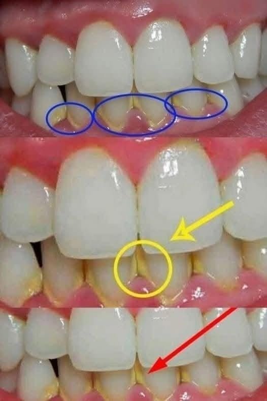 Can You Remove Dental Plaque Naturally in 5 Minutes? Here’s What You Should Know