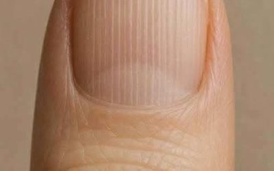 If you have lines on your nails, it means you have ca…See more😯⤵️