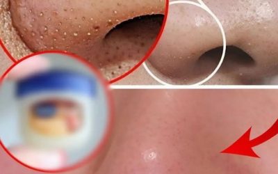 Remove Blackheads On Your Nose