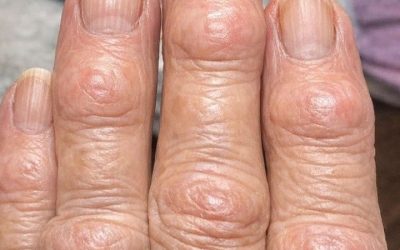 My grandma has these hard bumps forming on her finger joints near the nails. Why is this spreading?