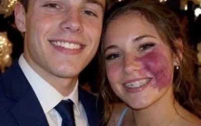 I was the only girl without a prom date because of my birthmark until one boy asked me — then police officers walked into the gym