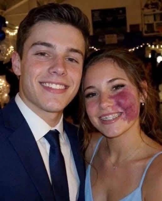 I was the only girl without a prom date because of my birthmark until one boy asked me — then police officers walked into the gym
