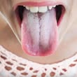 If your tongue is white, this is a clear sign that you are suffering from…