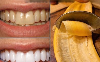 Secret Dentists They Don’t Want You to Meet: Removes Tartar and Whitens Teeth in Just 2 Minutes