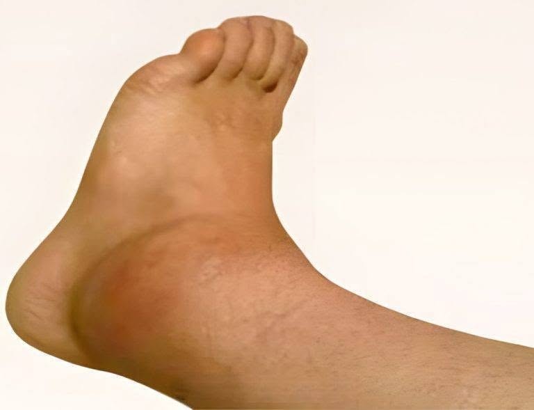 Swollen Ankles and Feet Explained: Causes Revealed!