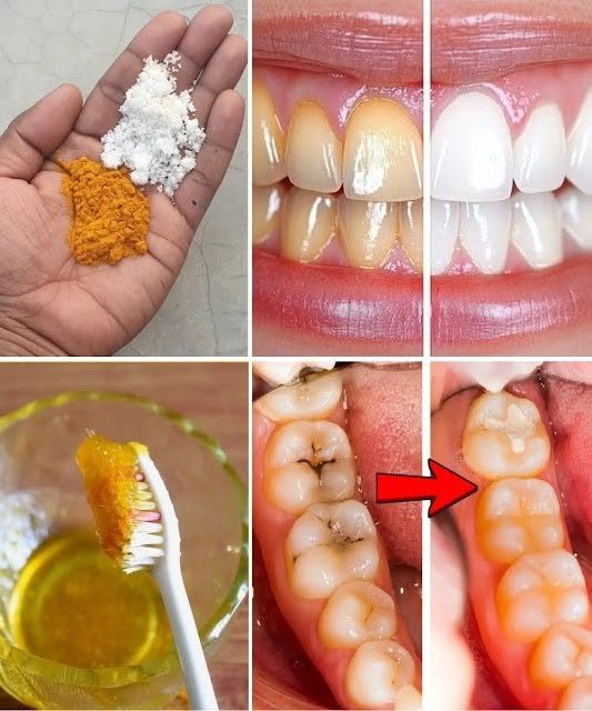 Please try this OUT !Turmeric for Teeth Whitening: Can This Natural Remedy Really Brighten Your Smile?..SEE MORE BELOW