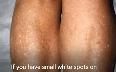 Small White Spots on Your Arms or Legs: What They Could Mean