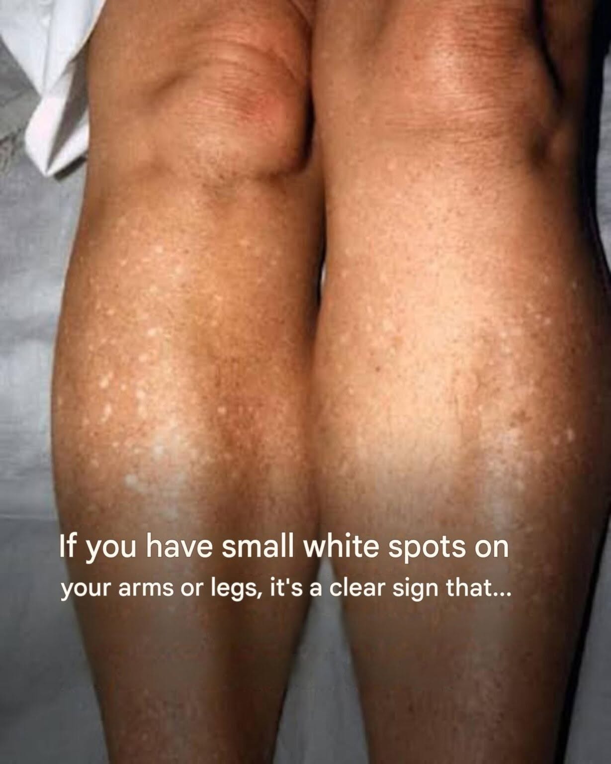 Small White Spots on Your Arms or Legs: What They Could Mean